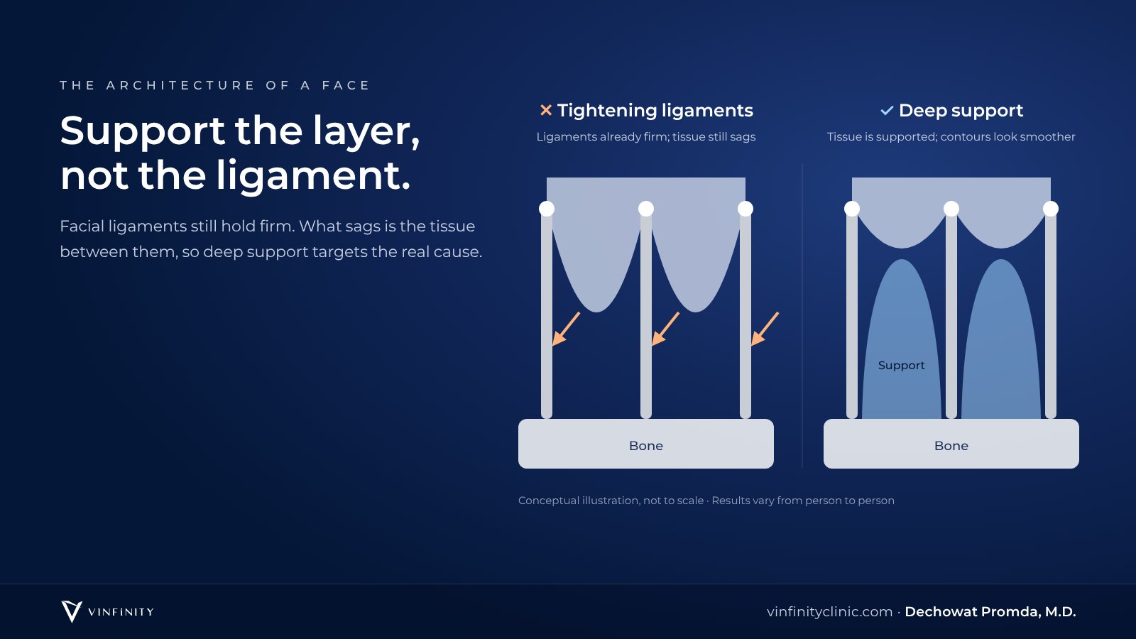 Comparison of injecting to tighten facial ligaments versus restoring deep support between the ligaments