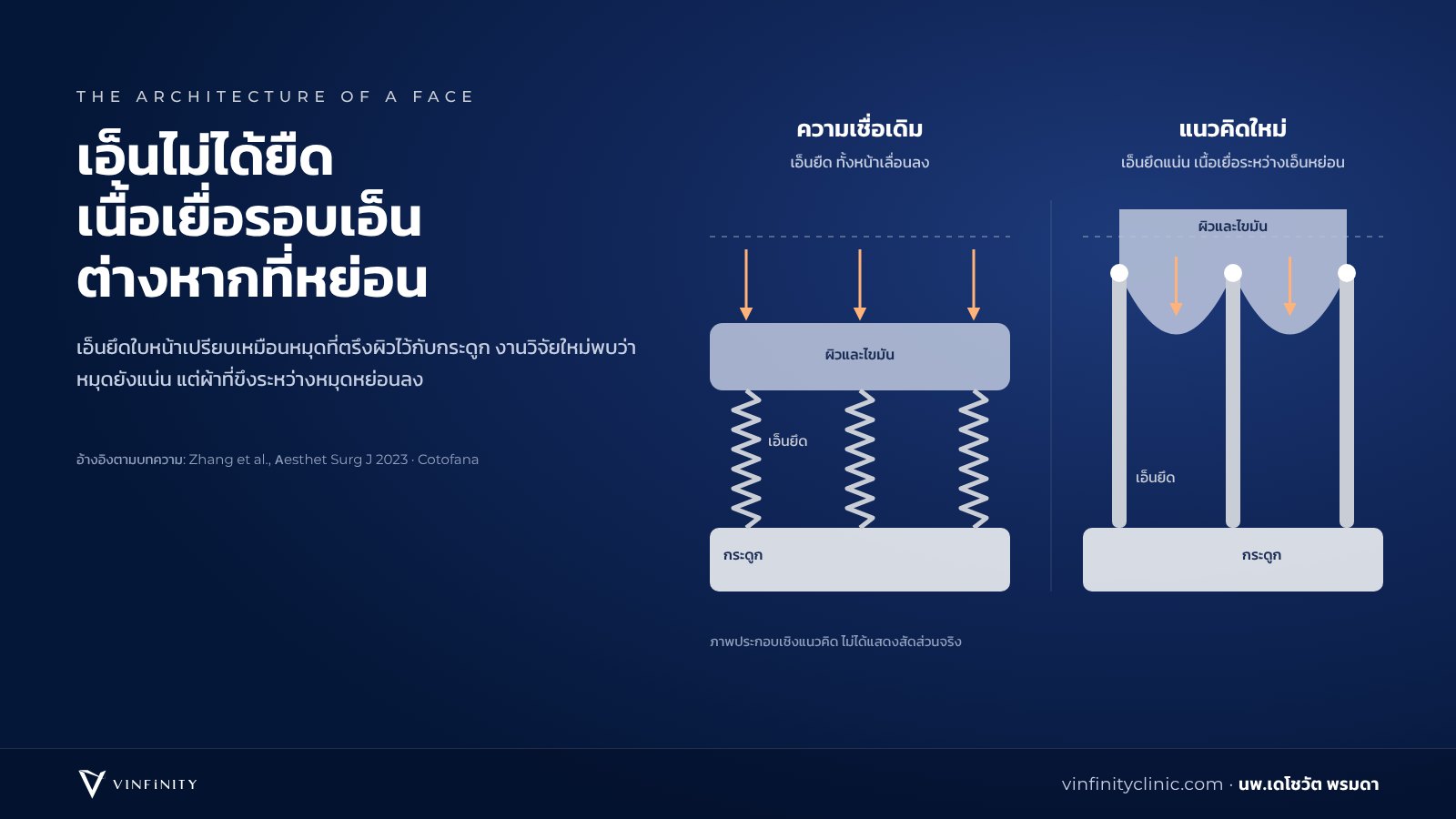 ภาพเปรียบเทียบความเชื่อเดิมว่าเอ็นยึดใบหน้ายืดตามอายุ กับแนวคิดใหม่ว่าเอ็นยังยึดแน่น แต่เนื้อเยื่อรอบเอ็นหย่อนลง