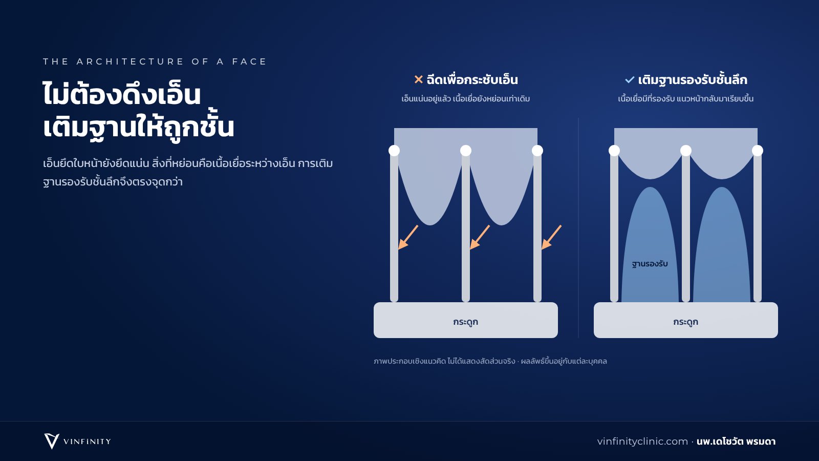 เปรียบเทียบการฉีดเพื่อกระชับเอ็นยึดใบหน้า กับการเติมฐานรองรับชั้นลึกระหว่างเอ็น