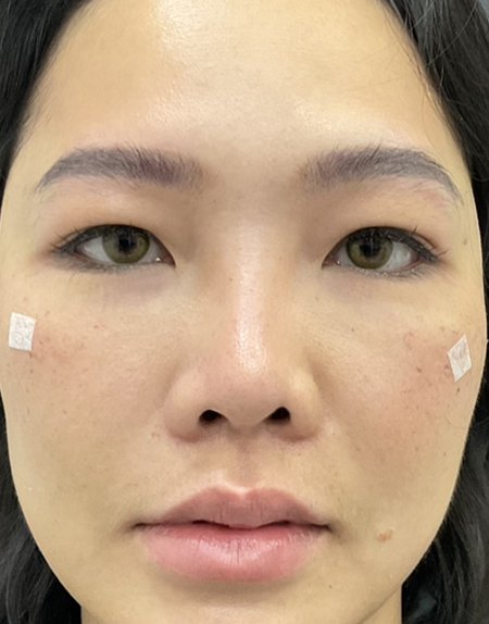 After, case 01: tear trough filler