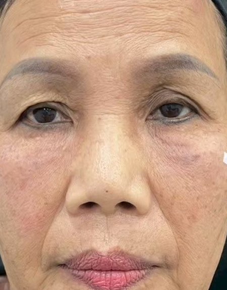 After, case 09: tear trough filler