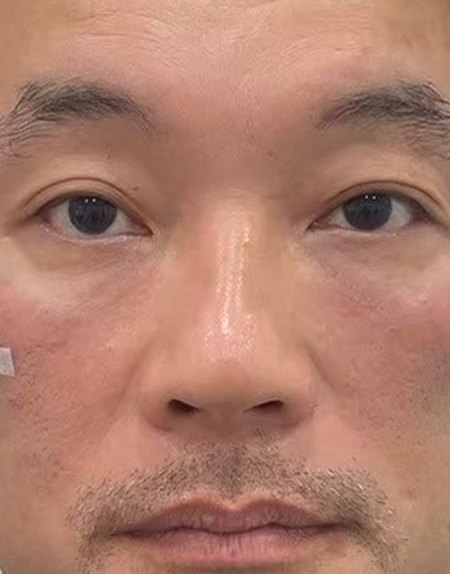 After, case 13: tear trough filler