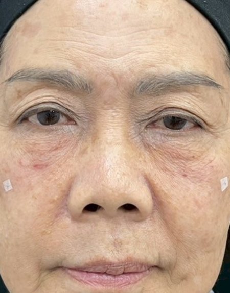After, case 15: tear trough filler