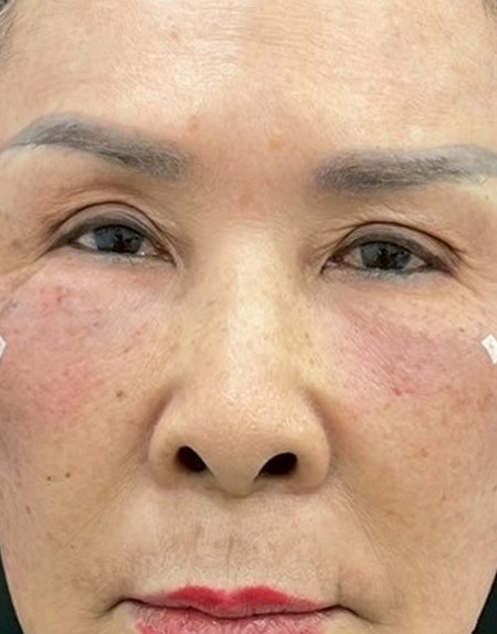 After, case 25: tear trough filler