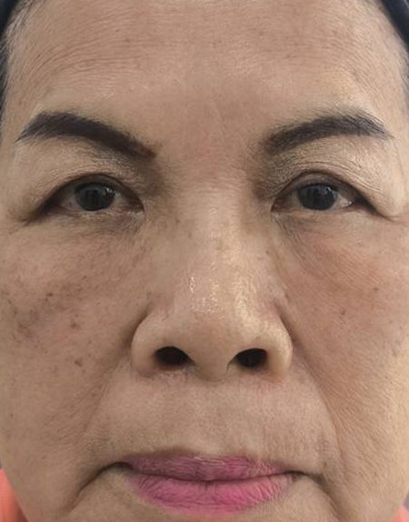 After, case 32: tear trough filler